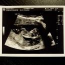 10 First Ultrasound 28 February 2018